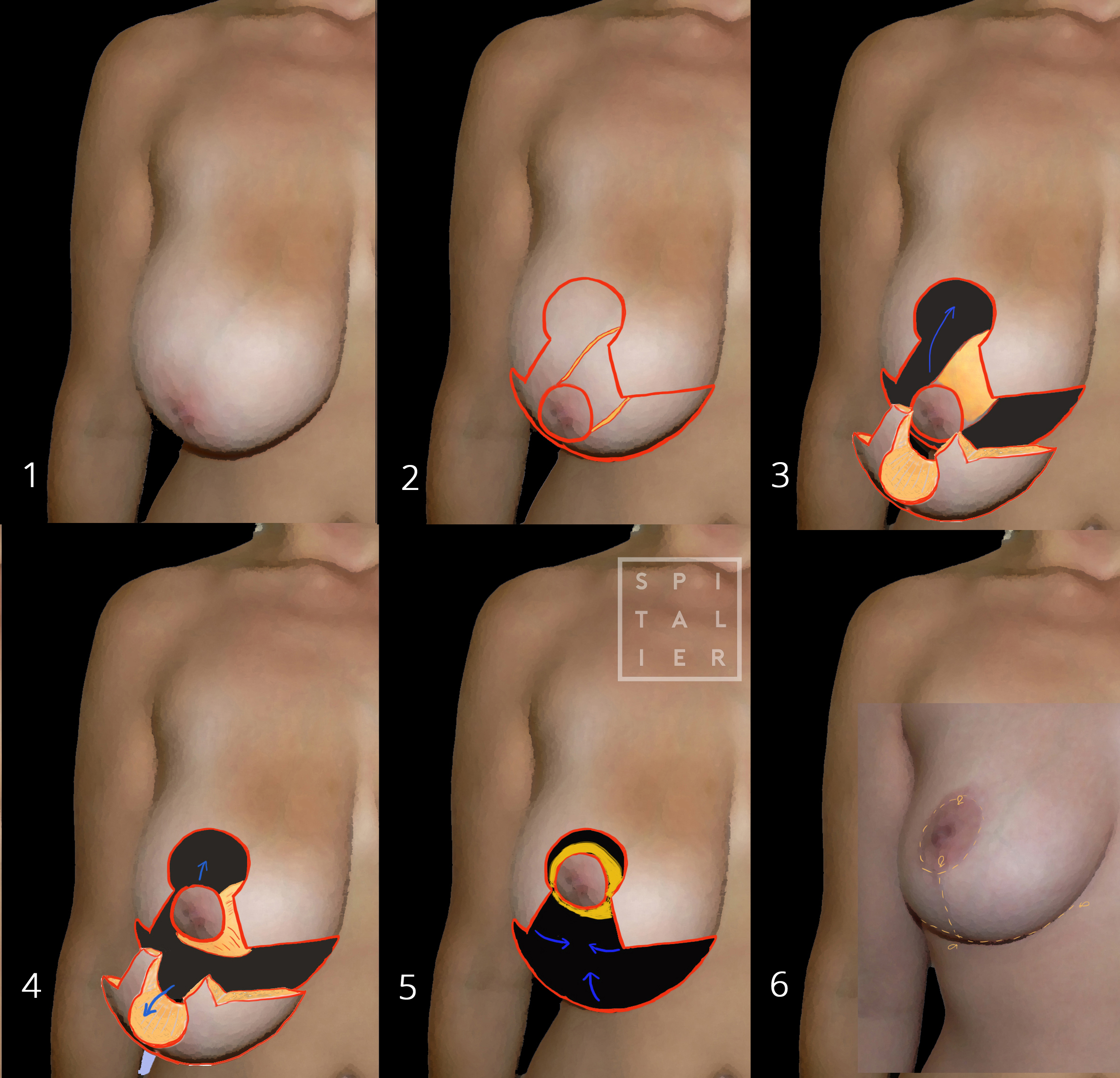 les étapes d'une plastie mammaire ou lifting des seins seins tombants lifting seins