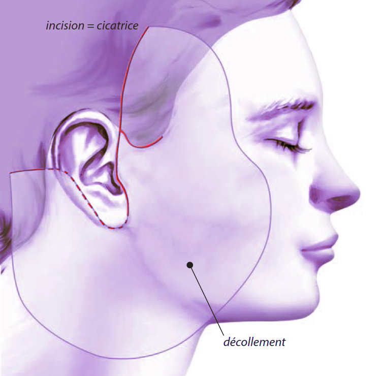 lifting décollement incision