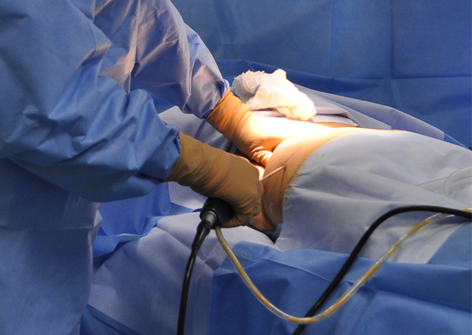 Lipoaspiration Docteur Spitalier clinique Argonay lipoaspiration liposuccion annecy Genève