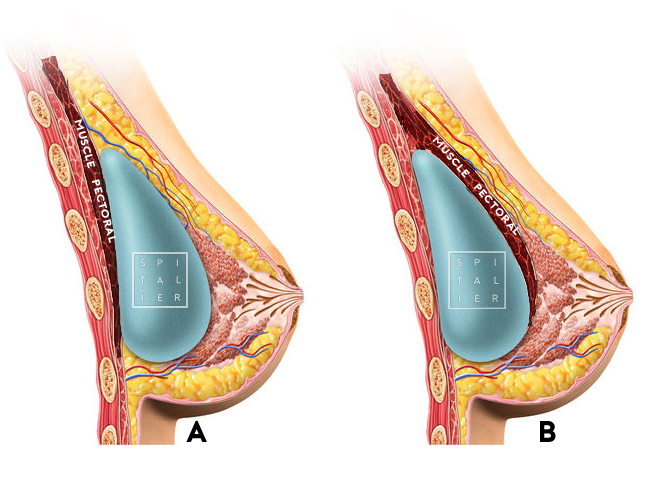 prothèse mammaire muscle pectoral