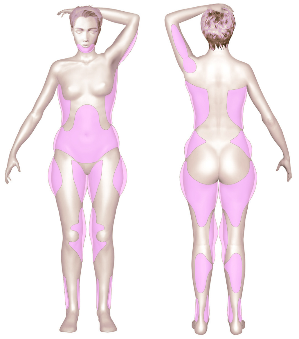 La lipoaspiration est indiquée sur les hanches les cuisses le ventre et les genoux lipoaspiration savoie suisse