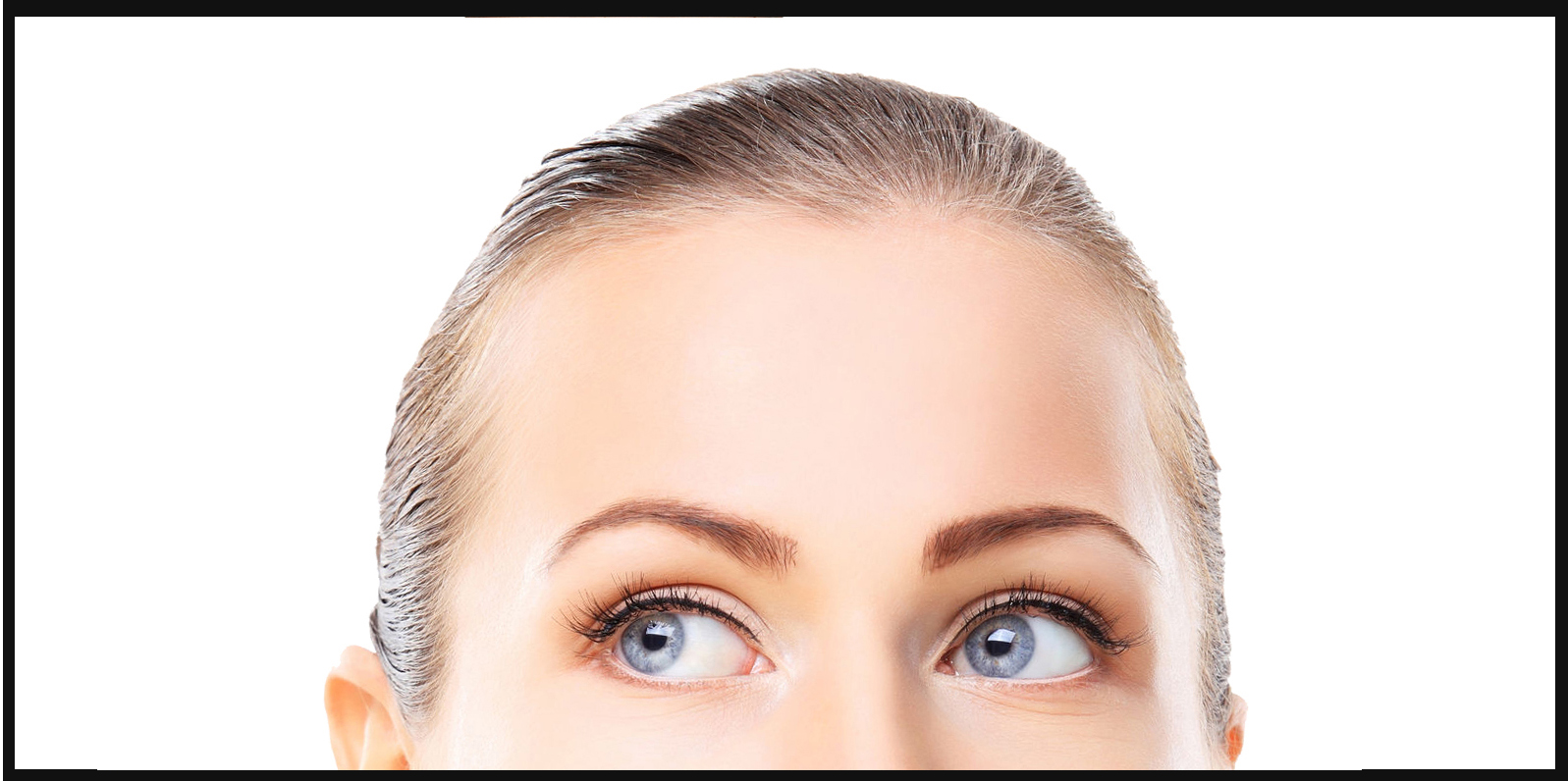 FEMME TRAITÉE PAR TOXINE BOTULIQUE BOTOX