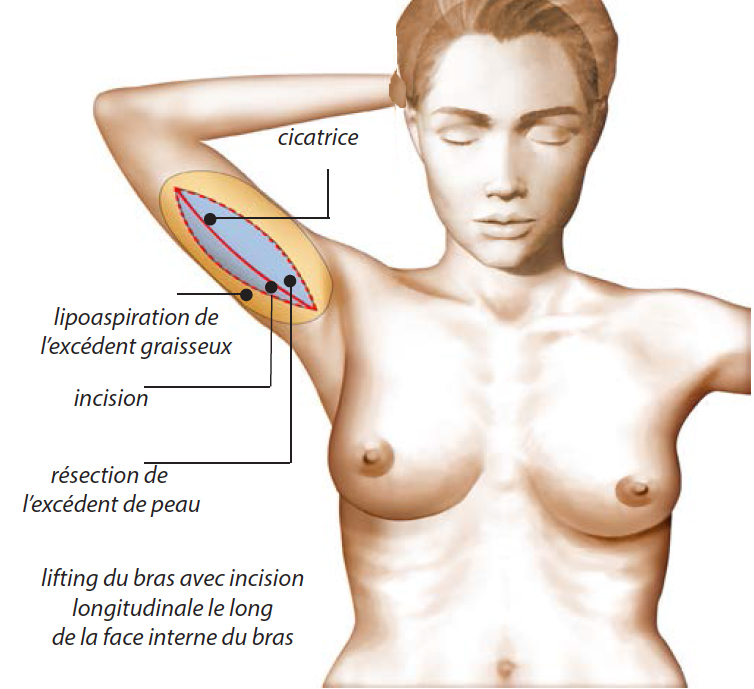 l'incision est à la face interne du bras lifting lipoaspiration du bras