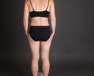 Can you lose weight with liposuction?