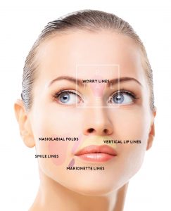 hyaluronic acid worrry lines nasolabial folds